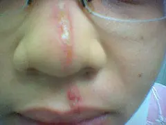 Blister Beetle Scarring Blister-Beetle-Scarring