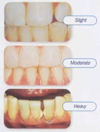 plaque teeth