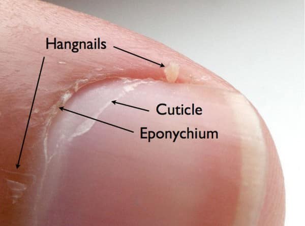 hangnail