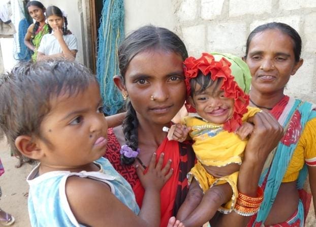 Kids suffering from Cleft