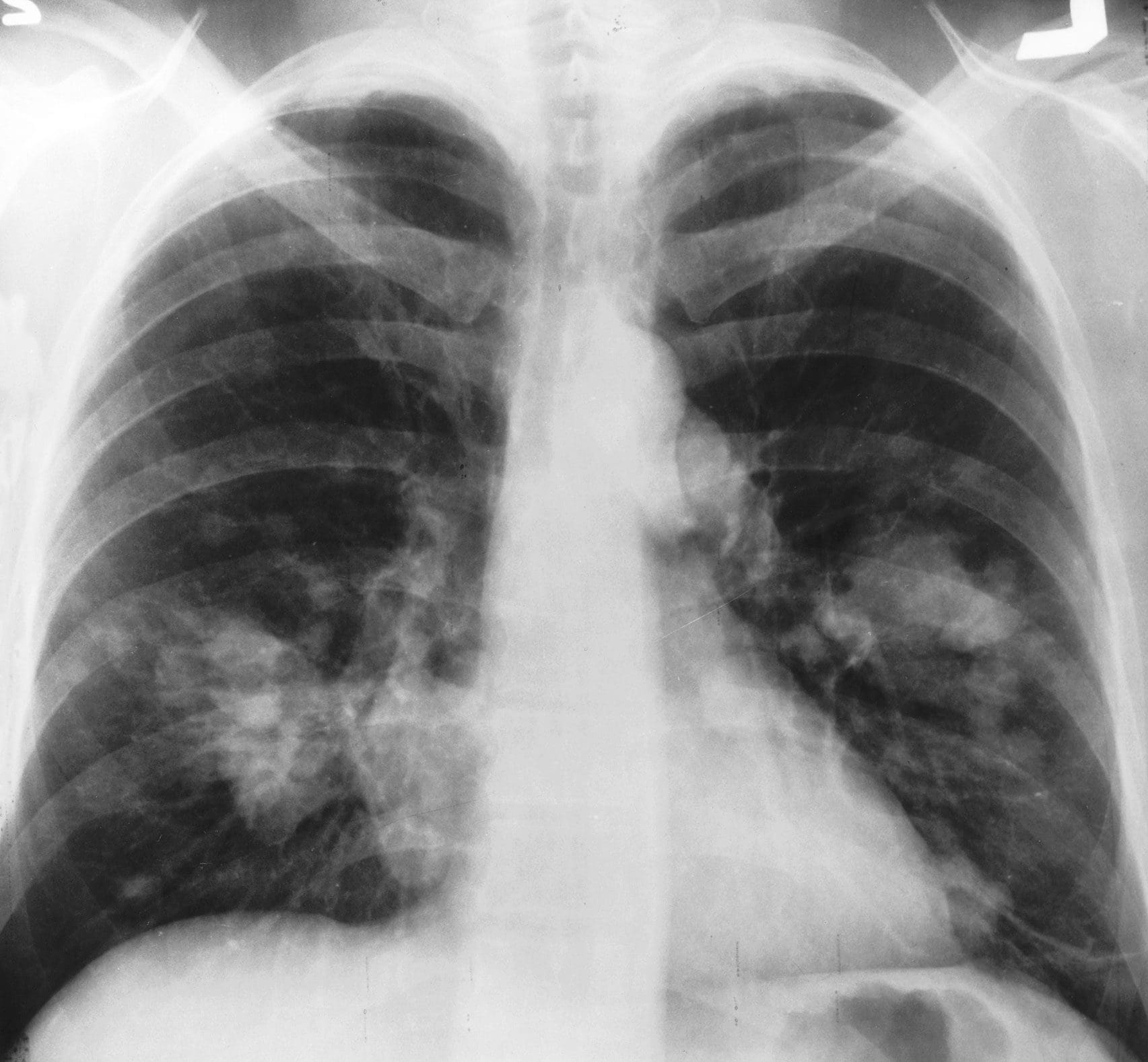 X ray chest cancer