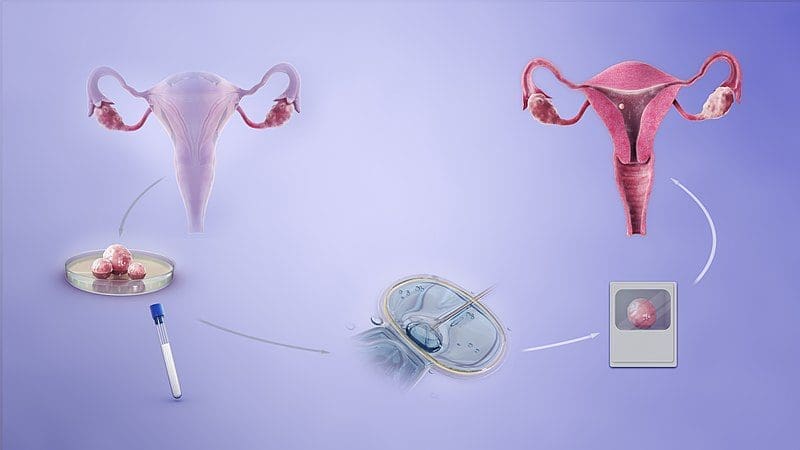 In vitro fertilization and infertilty