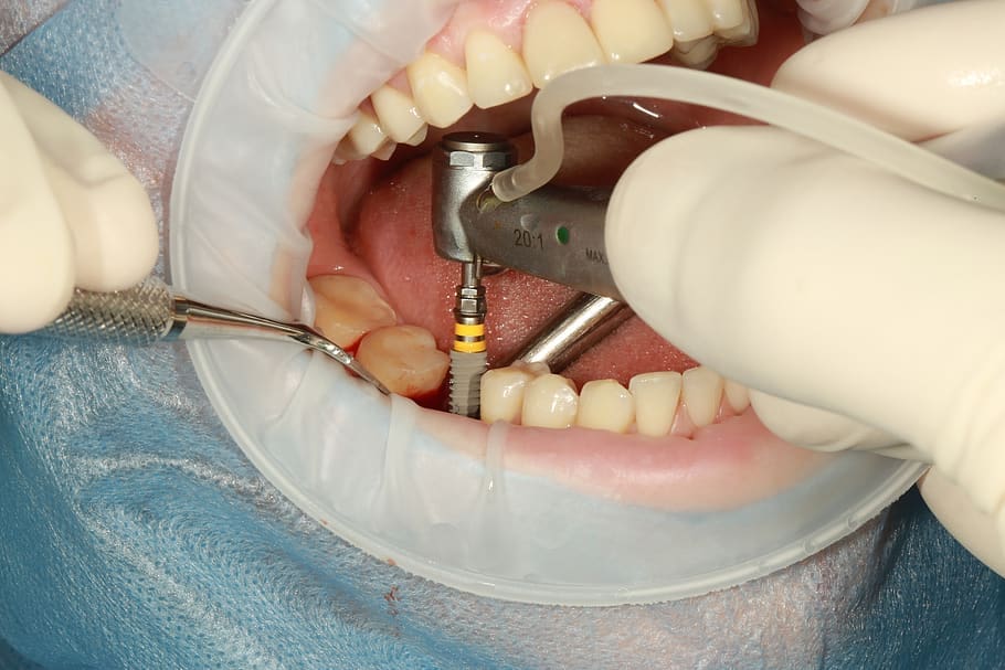 dental-implants-surgery dental implants