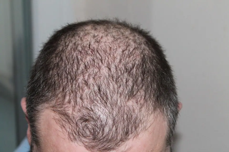 hair transplant surgery