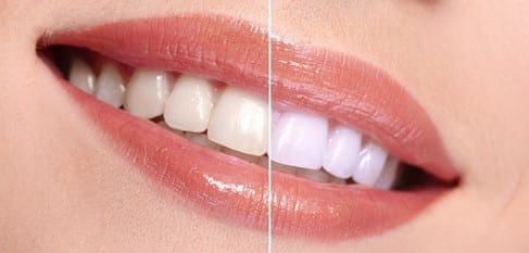 Teeth Whitening Before After