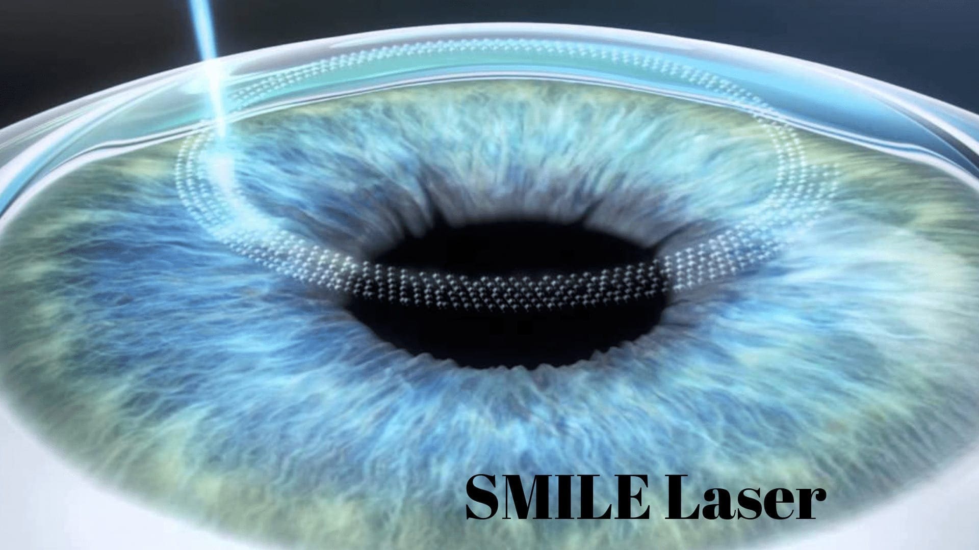 smile eye surgery