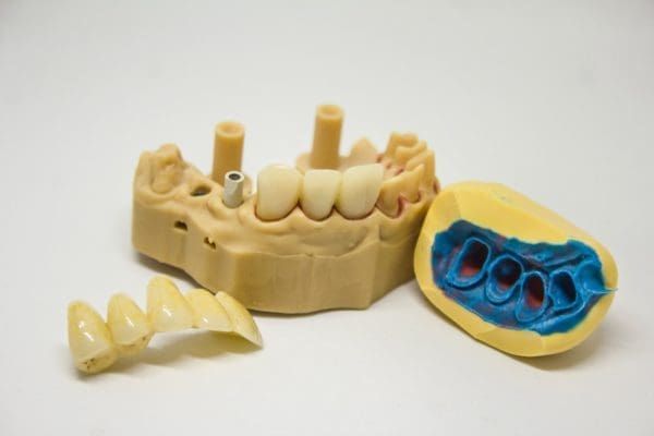 dental implant tooth cavity