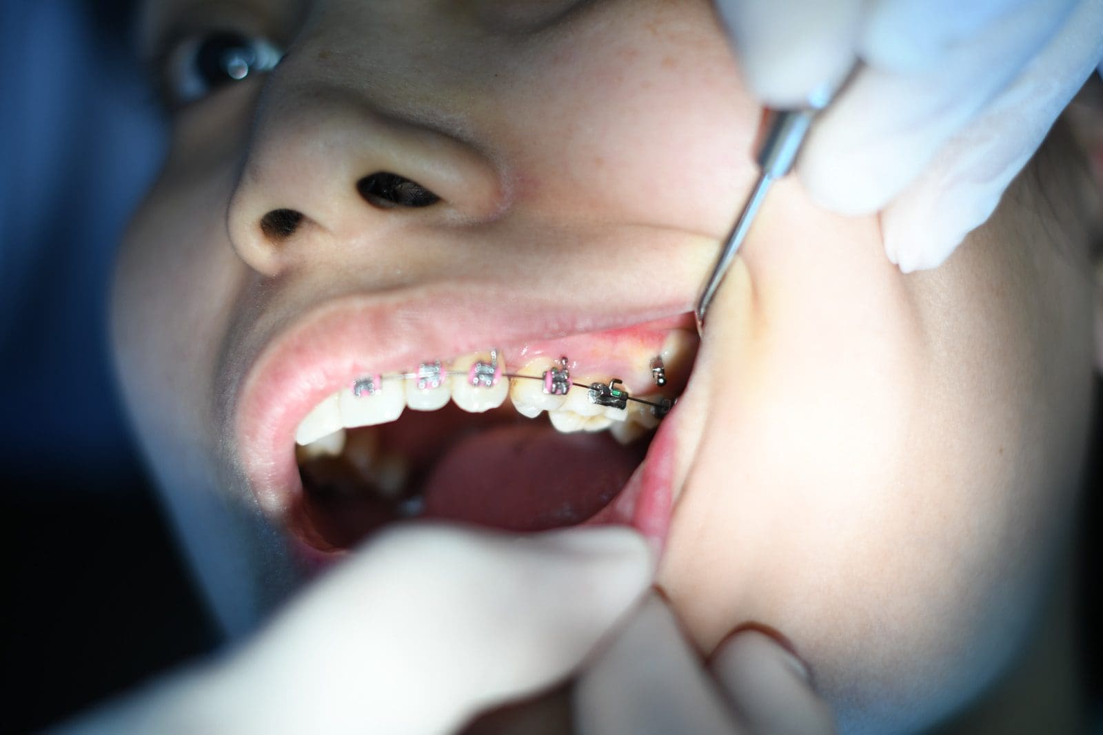 wisdom teeth person with silver teeth braces