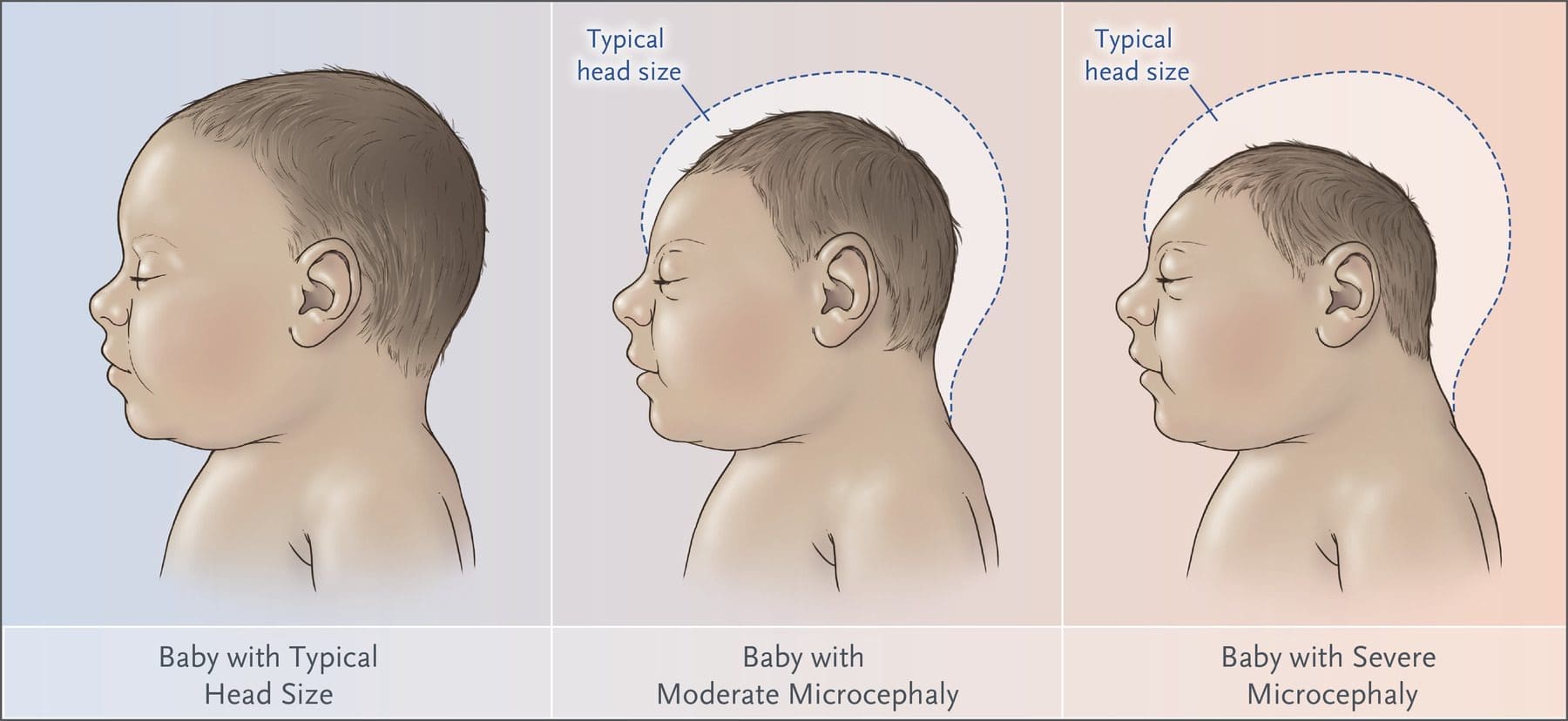 zika virus microcephaly