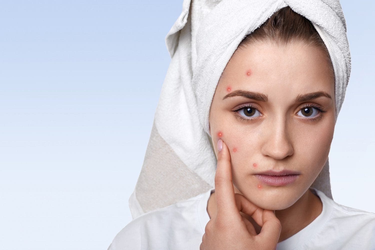 cosmetic companies acne