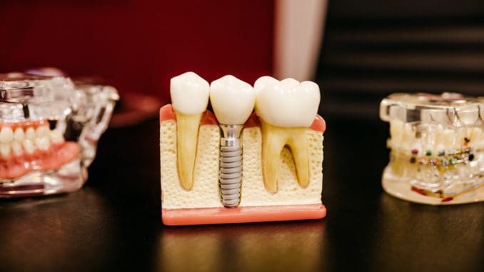 Photo by Jonathan Borba root canal white and yellow wooden condiment shakers