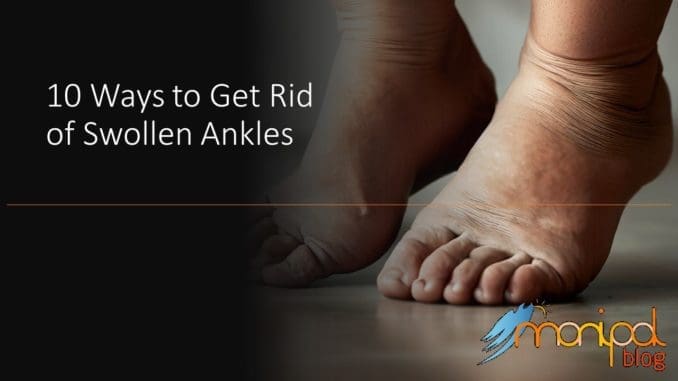 10 Ways to Get Rid of Swollen Ankles