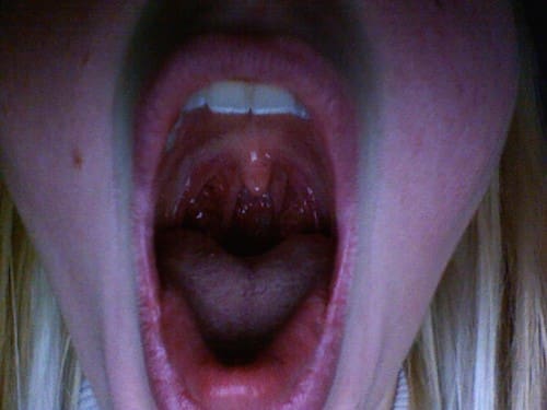 mouth sores