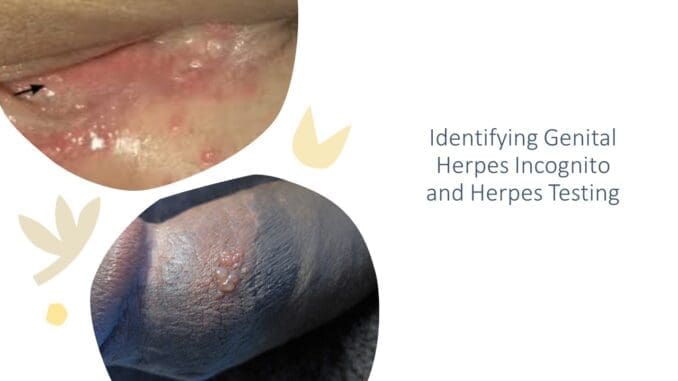Genital Herpes Genital Herpes