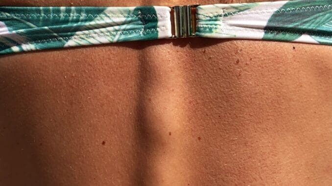 green and white bikini top skin cancer